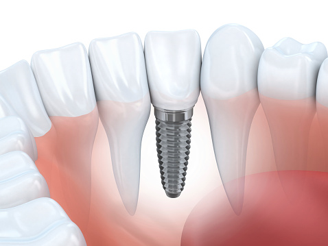 Rendering of a dental implant with other teeth in a row.