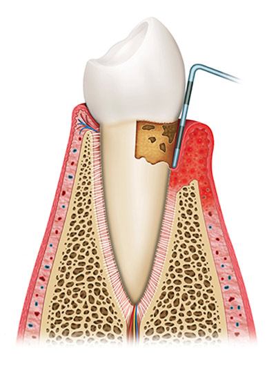 Diagram rendering of root planing, at Fusion Dental Specialists in Happy Valley, OR.