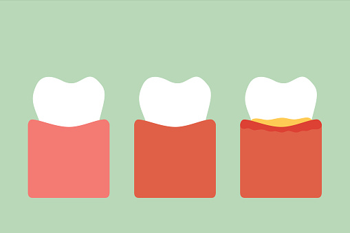 Image of tooth being treated with antibiotic treatment.