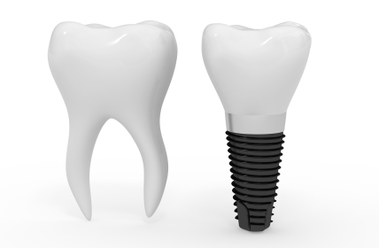 Dental Implant and molar side by side