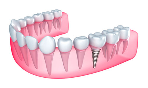 Diagram of a dental implant located in the bottom right corner of the mouth in Happy Valley, OR.