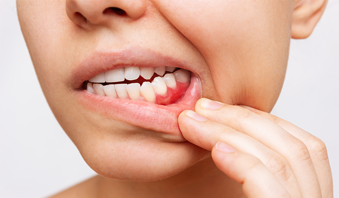 Image of a person showing infected gums, at Fusion Dental Specialists in Happy Valley, OR.