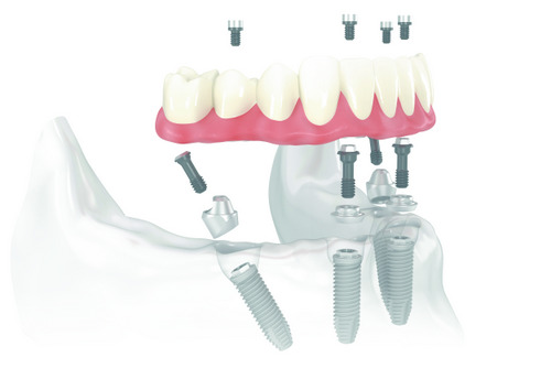 Diagram of All-on-4 Treatment Concept, at Fusion Dental Specialists in Happy Valley, OR.