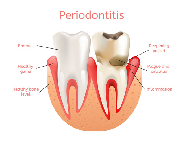 Diagram of a healthy tooth versus a tooth with periodontitis, at Fusion Dental Specialists in Happy Valley, OR.