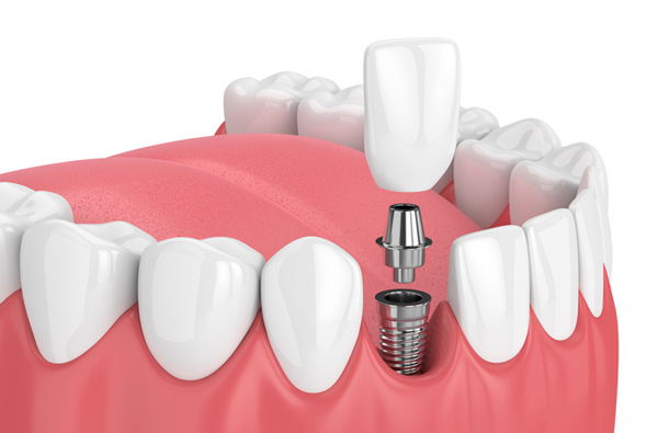 Rendering of jaw with dental implant at Fusion Dental Specialists, in Happy Valley, OR.
