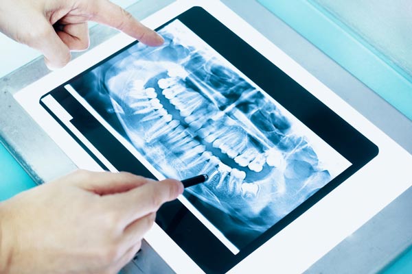 Dental x-ray of a full mouth, at Fusion Dental Specialists in Happy Valley, OR.