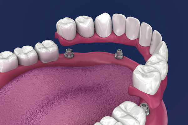 3D rendering of overdentures in a mouth