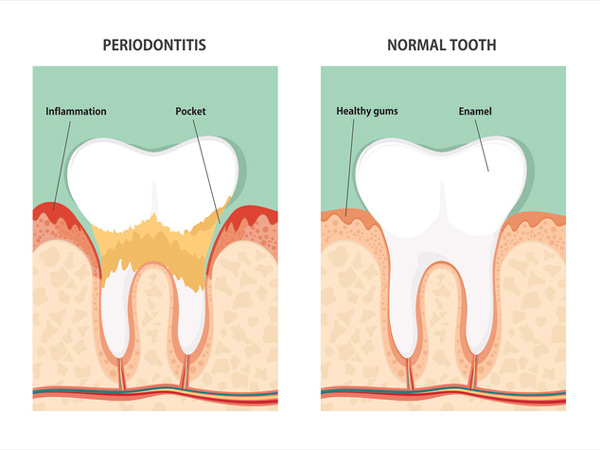 Diagram of periodontitis and healthy tooth.