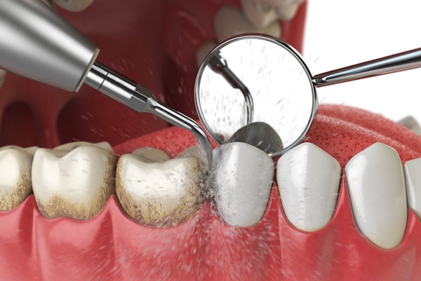 Diagram of a teeth and gum cleaning.