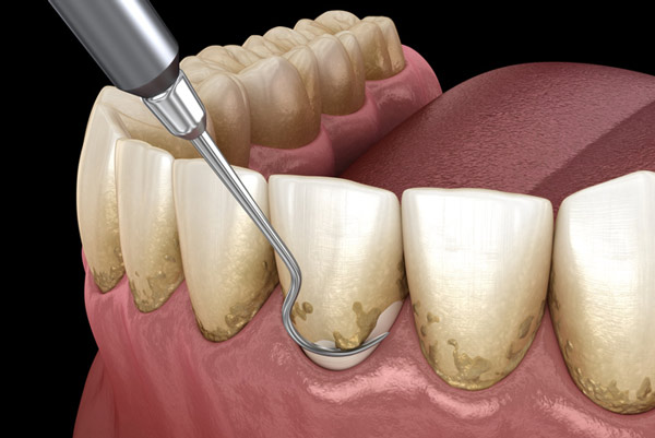 Diagram of teeth getting root planing.